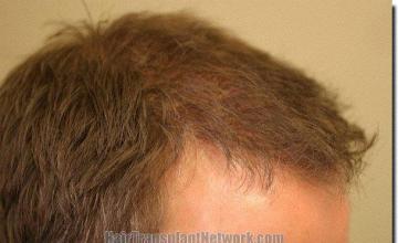 Hair restoration procedure results