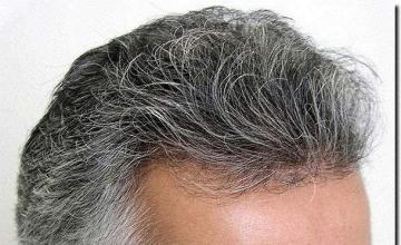 Hair restoration procedure results