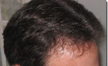 Hair restoration procedure results