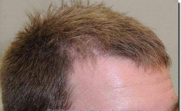 Hair restoration procedure results