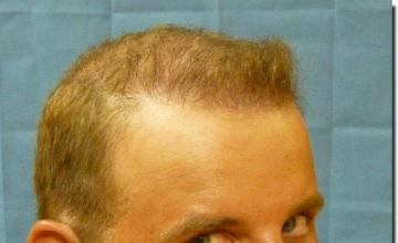 Hair restoration procedure results