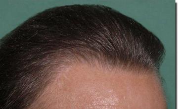 Hair restoration procedure results