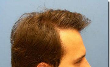 Hair restoration procedure results