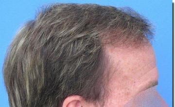 Hair restoration procedure results