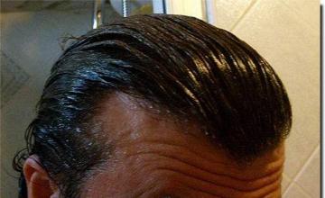 Hair restoration procedure results