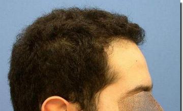 Hair restoration procedure results