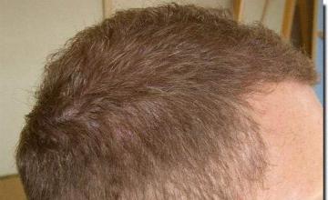 Hair restoration procedure results