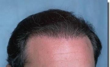 Hair restoration procedure results