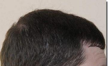 Hair restoration procedure results