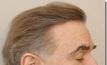 Hair restoration procedure results