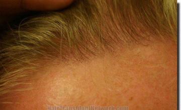 Hair restoration procedure results