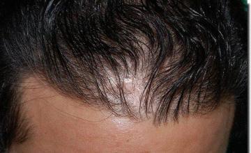 Hair restoration procedure results