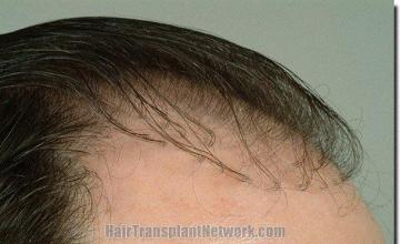 Hair restoration procedure results