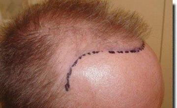 Hair restoration procedure results