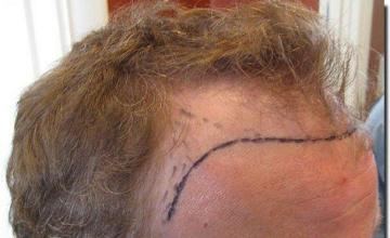 Hair restoration procedure results