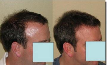 Hair restoration procedure results