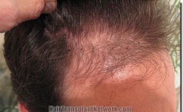 Hair restoration procedure results