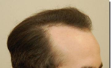 Hair restoration procedure results