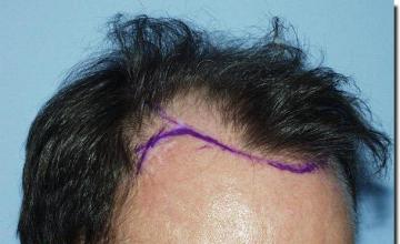 Hair restoration procedure results