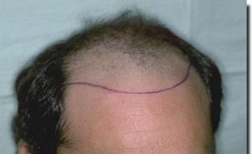 Hair restoration procedure results
