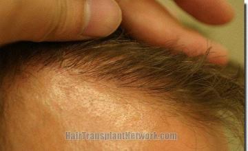 Hair restoration procedure results