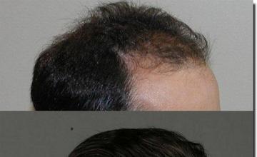 Hair restoration procedure results