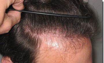 Hair restoration procedure results