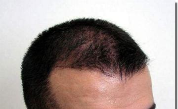 Hair restoration procedure results