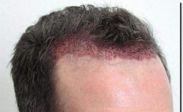 Hair restoration procedure results