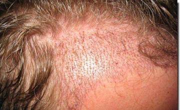 Hair restoration procedure results