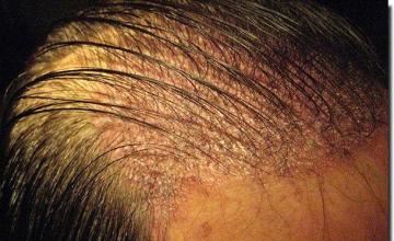 Hair restoration procedure results