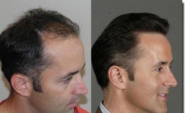 Hair restoration procedure results