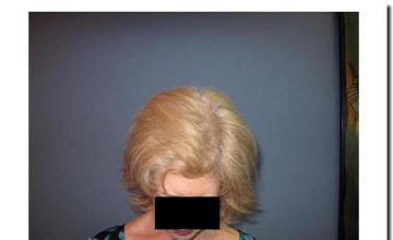 Hair restoration procedure results