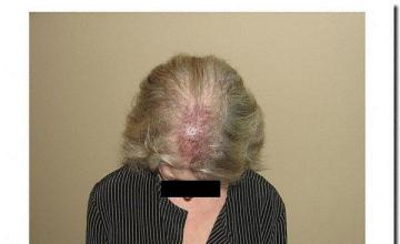 Hair restoration procedure results