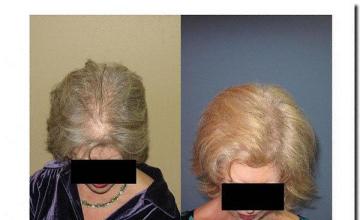 Hair restoration procedure results