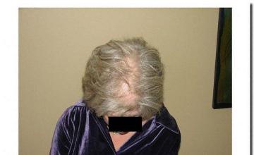 Hair restoration procedure results