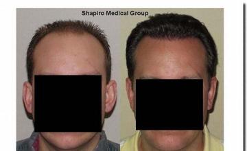 Hair restoration procedure results