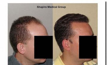 Hair restoration procedure results