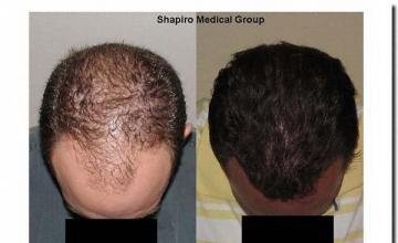 Hair restoration procedure results