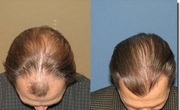 Hair restoration procedure results