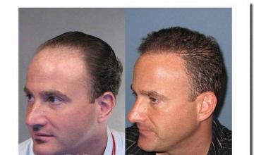 Hair restoration procedure results