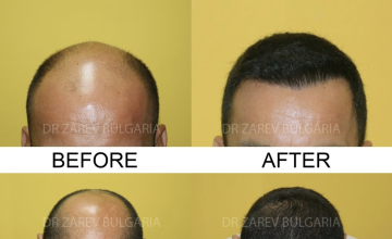 Before and after
