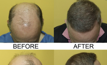 Top down and Side View before and after
