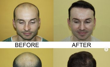 Before and After 