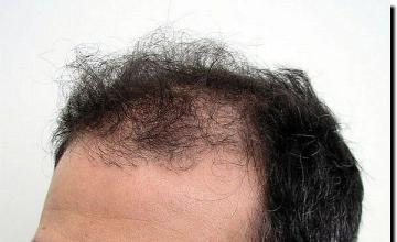 Hair restoration procedure results