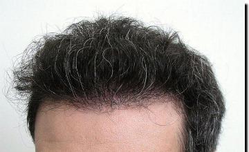 Hair restoration procedure results