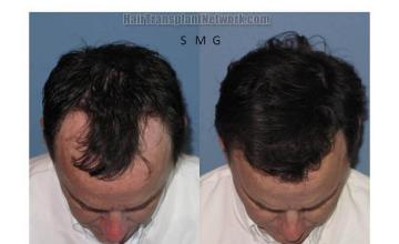 Top view before and after hair restoration images