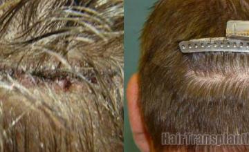 Residual scar photo before and after images