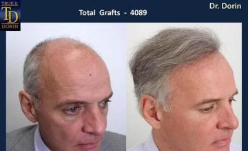 Before and after hair transplant procedure photograph