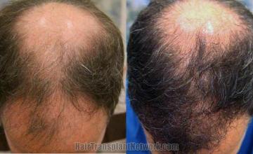 Before and after hair restoration procedure photos